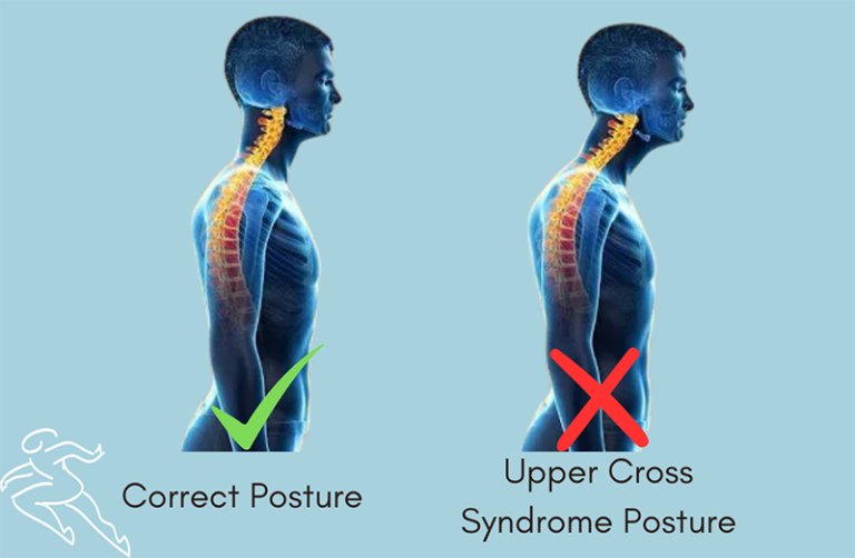 Understanding And Treating Upper Cross Syndrome | Dynamic Spine And ...