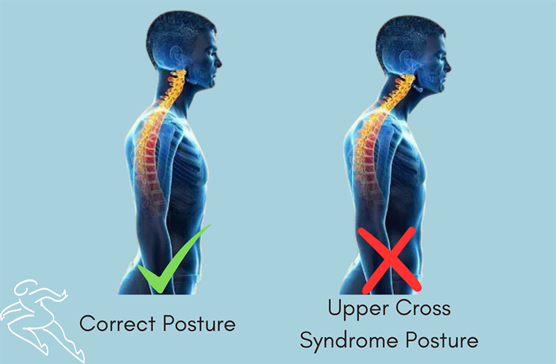 Correct and incorrect postures for Upper Cross Syndrome.
