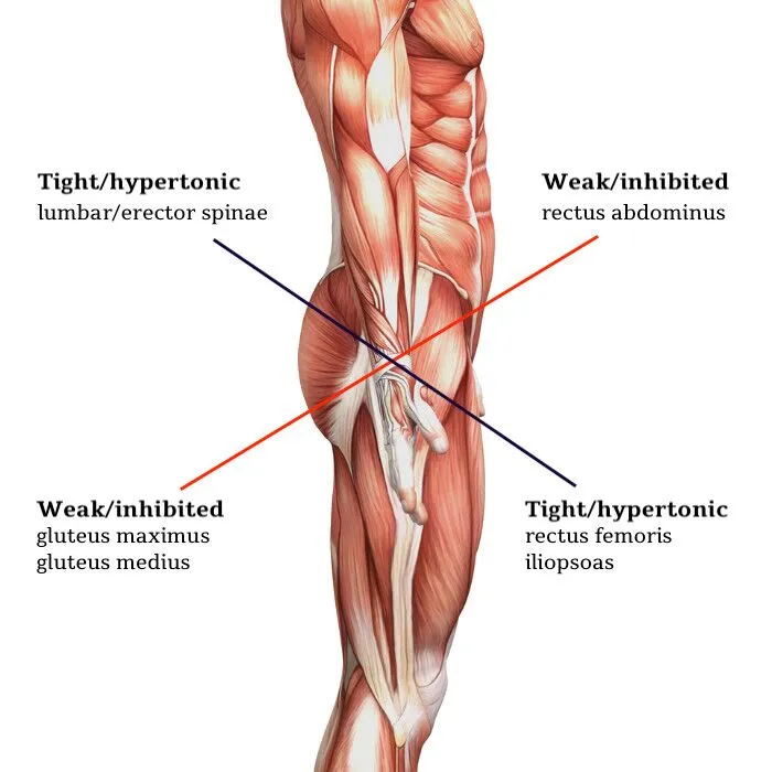 Muscle areas involved in Lower Cross Syndrome.